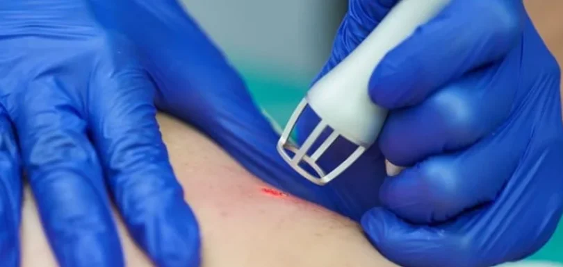 Laser Surgery